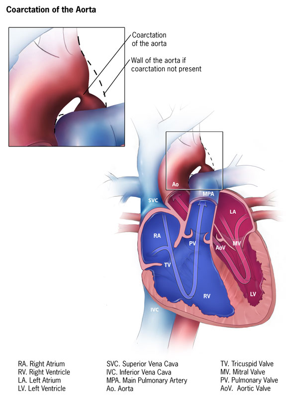 <p>Coarctation of the Aorta. This illustration details the anatomy of the heart and coarctation of the aorta.</p>