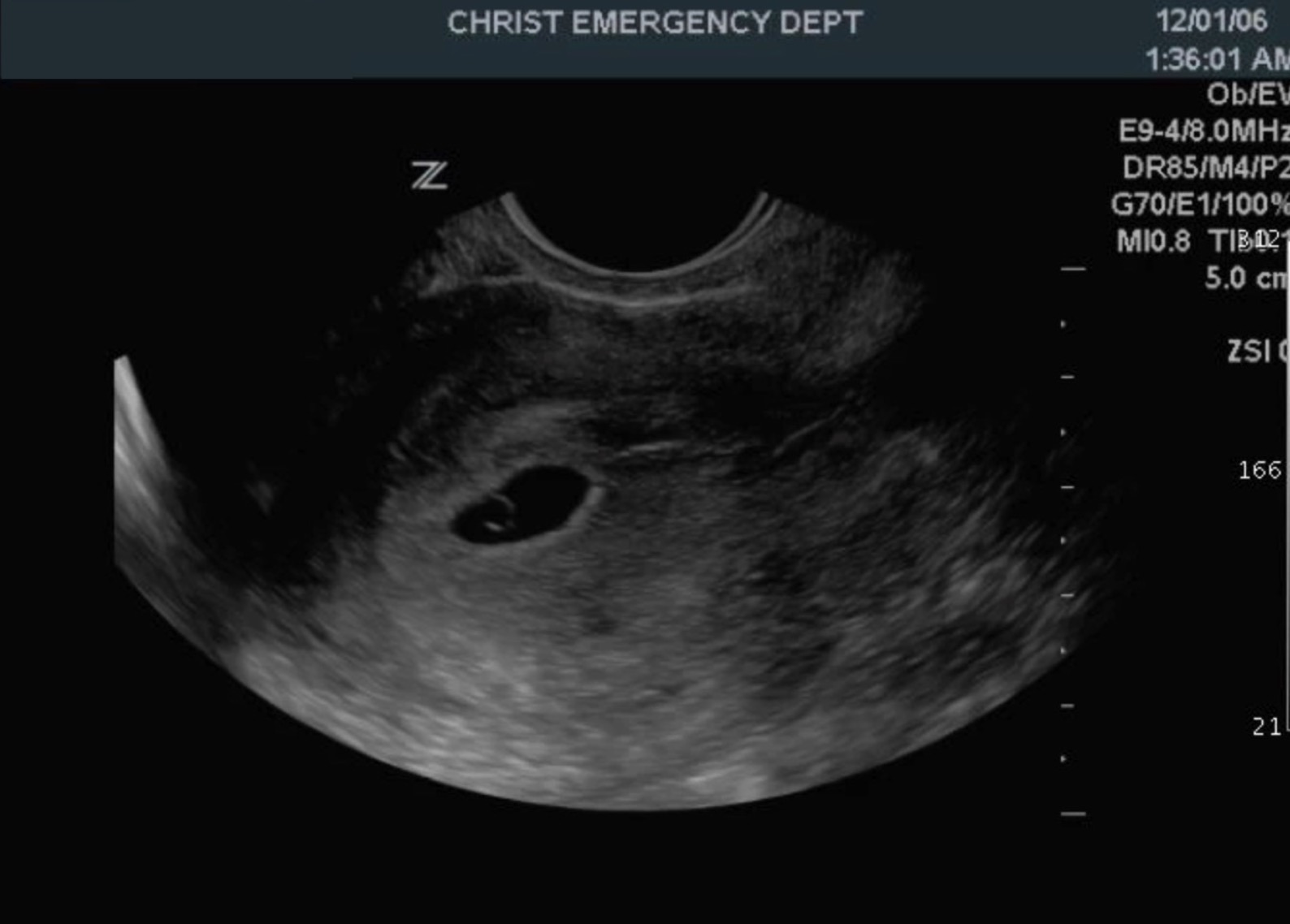 <p>Gestational Sac. The gestational sac (GS) is within the endometrial echo of the uterus and contains a yolk sac (YS).</p>