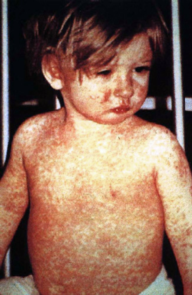 <p>Measles, Day 4 Rash. This child shows a classic day 4 rash with measles.</p>