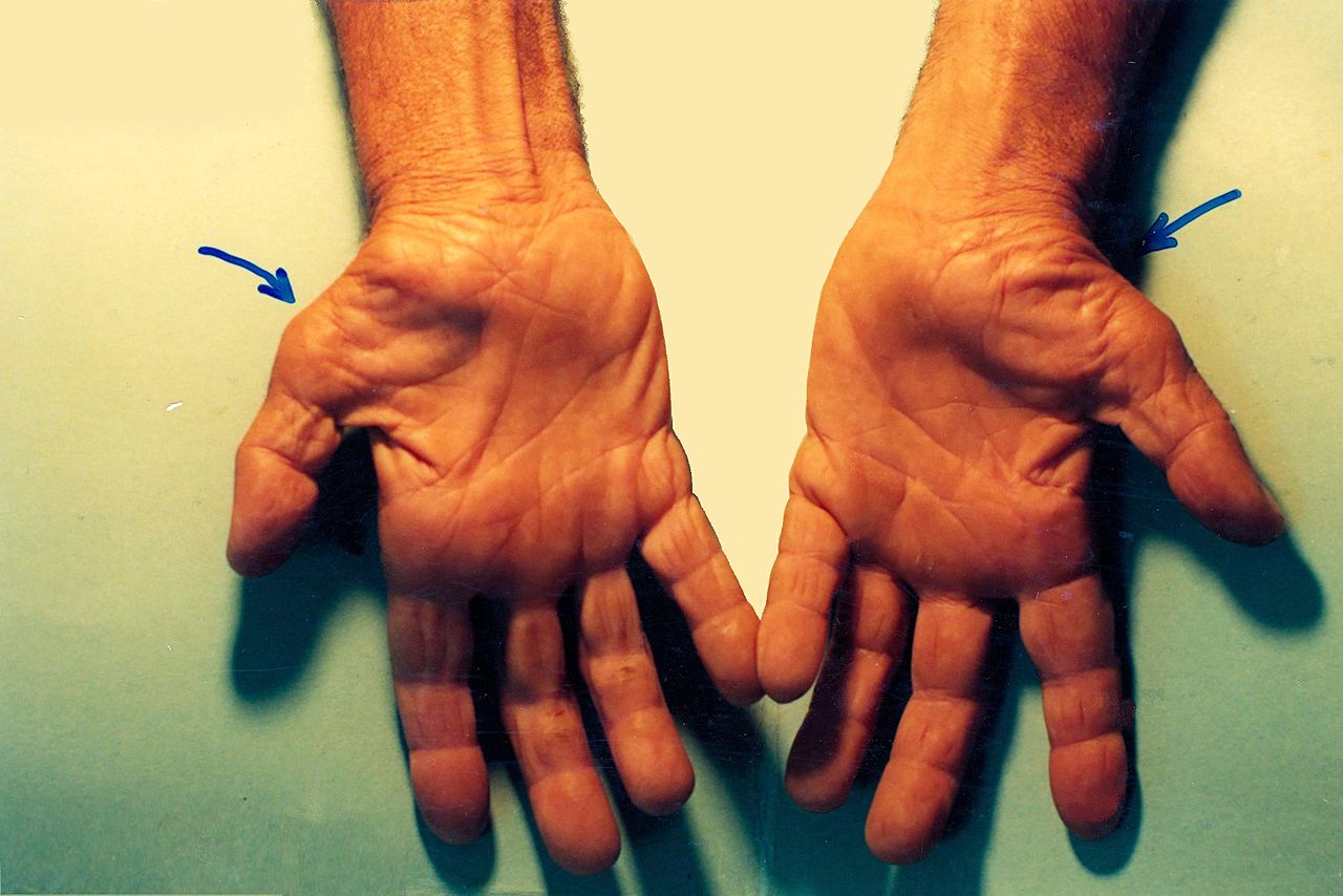 <p>Signs of Untreated Carpal Tunnel Syndrome