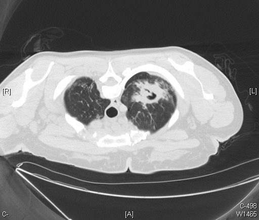 <p>CT Scan, Cavitary Tuberculosis, Pulmonary Scan</p>