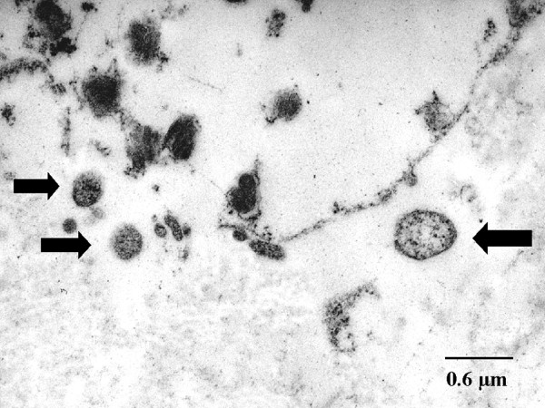 <p>Alpha-1 Antitrypsin Deficiency in Emphysema, Transmission Electron Microscopy