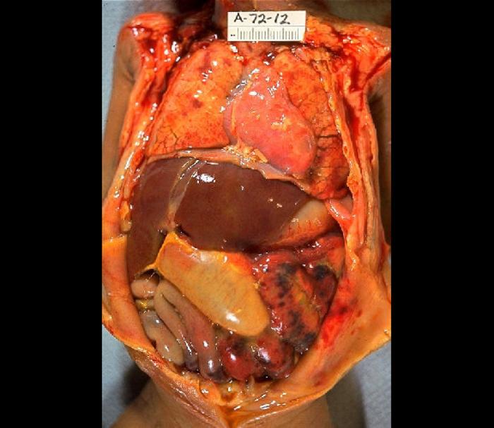 <p>Gross Pathology of Neonatal Necrotizing Enterocolitis