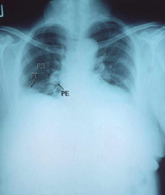 <p>Right Pulmonary Arterial Embolism