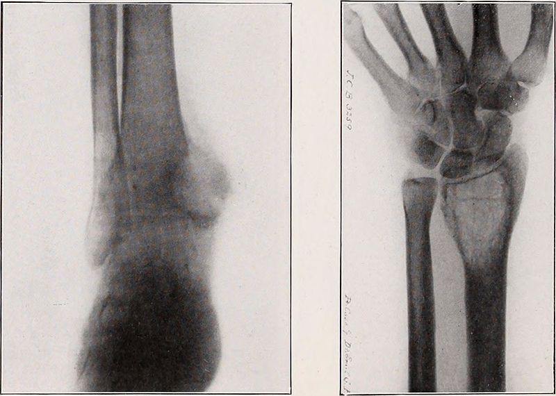 <p>Tuberculosis Benign Bone Cyst, Radius, Ulnar