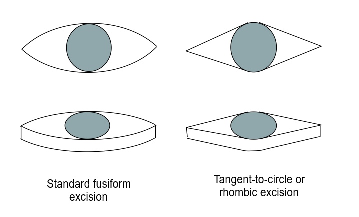 <p>Fusiform Incision and Excision