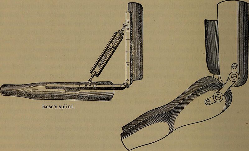 <p>Rose and Welch Splints