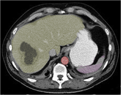 <p>Hepatic Abscess