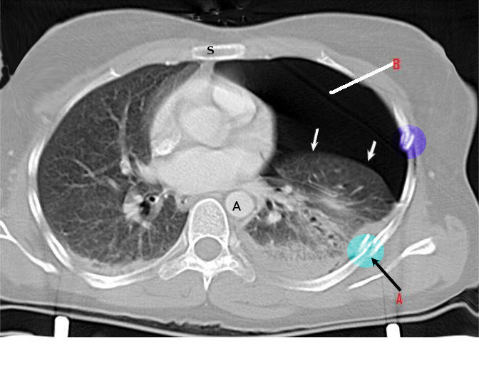 <p>Computed Tomography, Rib&nbsp;Fracture