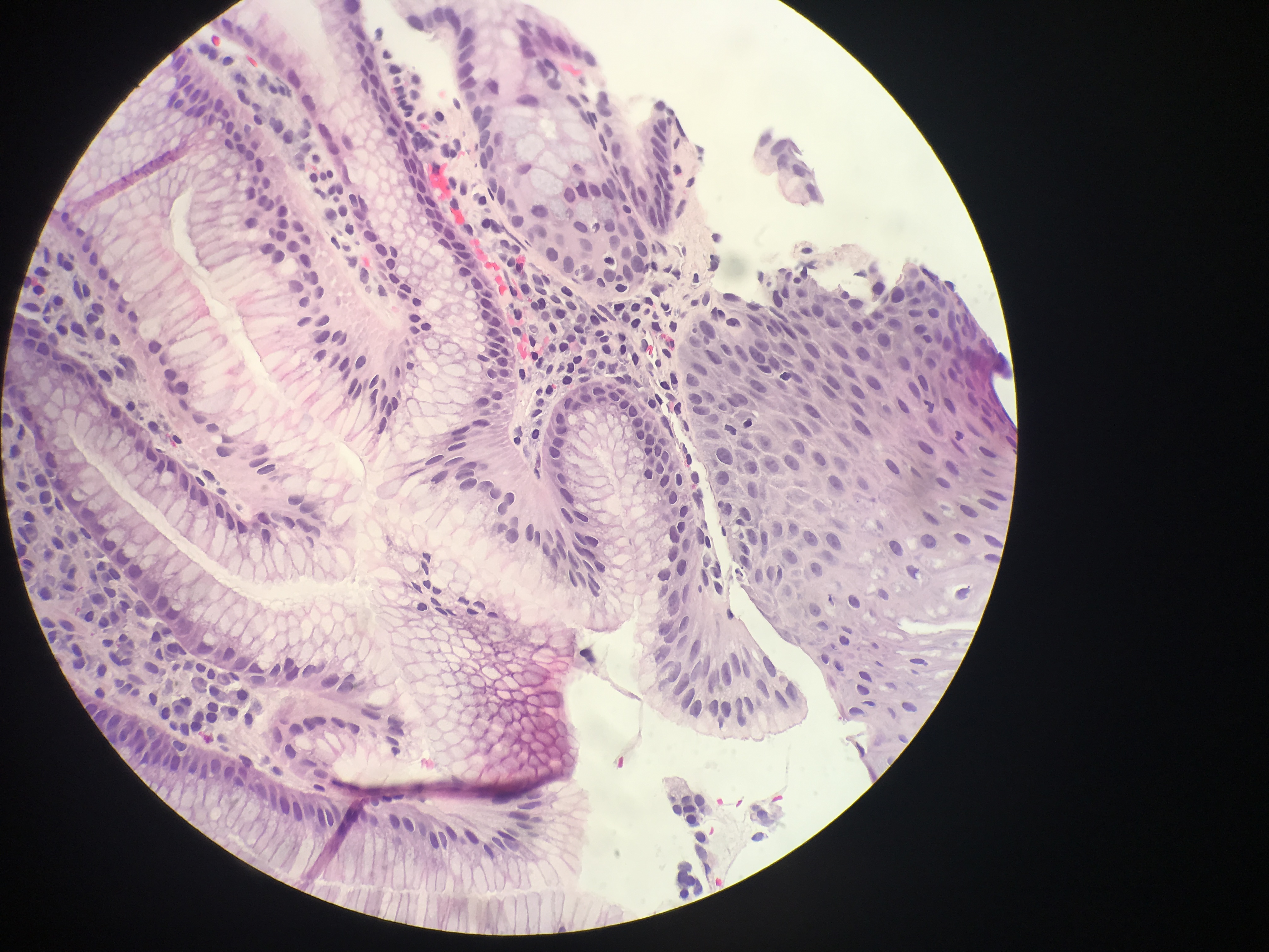 <p>Barrett Esophagus. Squamocolumnar junction with focal goblet cells.</p>