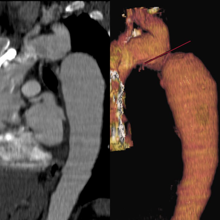 <p>Coarctation of the Aorta on a Computed Tomography (CT) Scan and Magnetic Resonance Imaging (MRI)