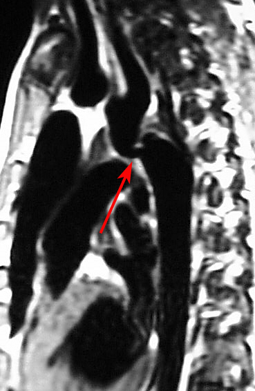 <p>Coarctation of the Aorta Demonstrated on Cardiac Magnetic Resonance Imaging (MRI)