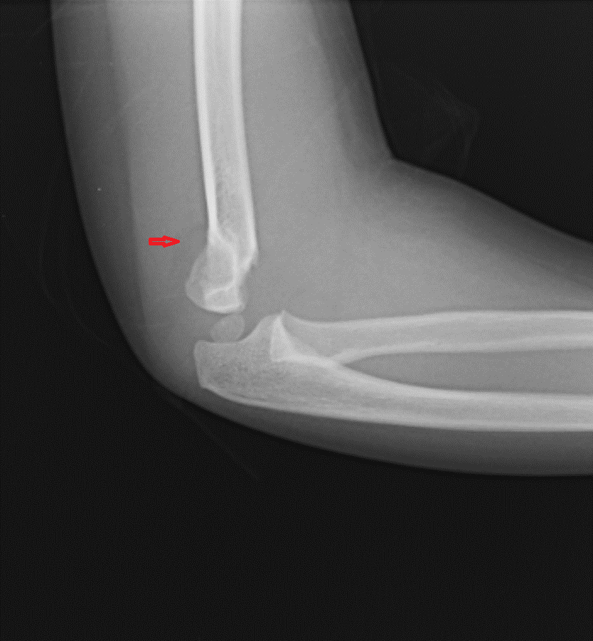 <p>Posterior Fat Pad Sign in Supracondylar Fracture