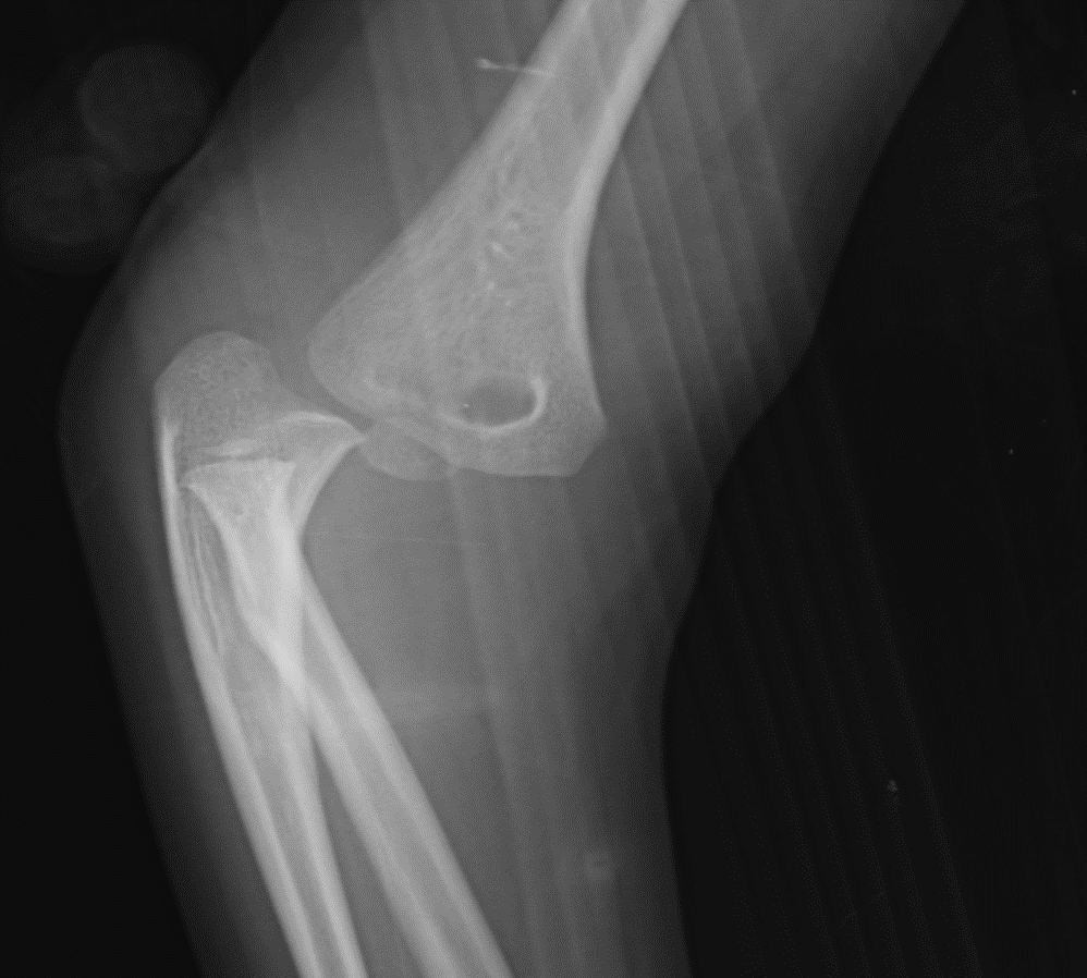 <p>Elbow Fracture on Lateral Radiography