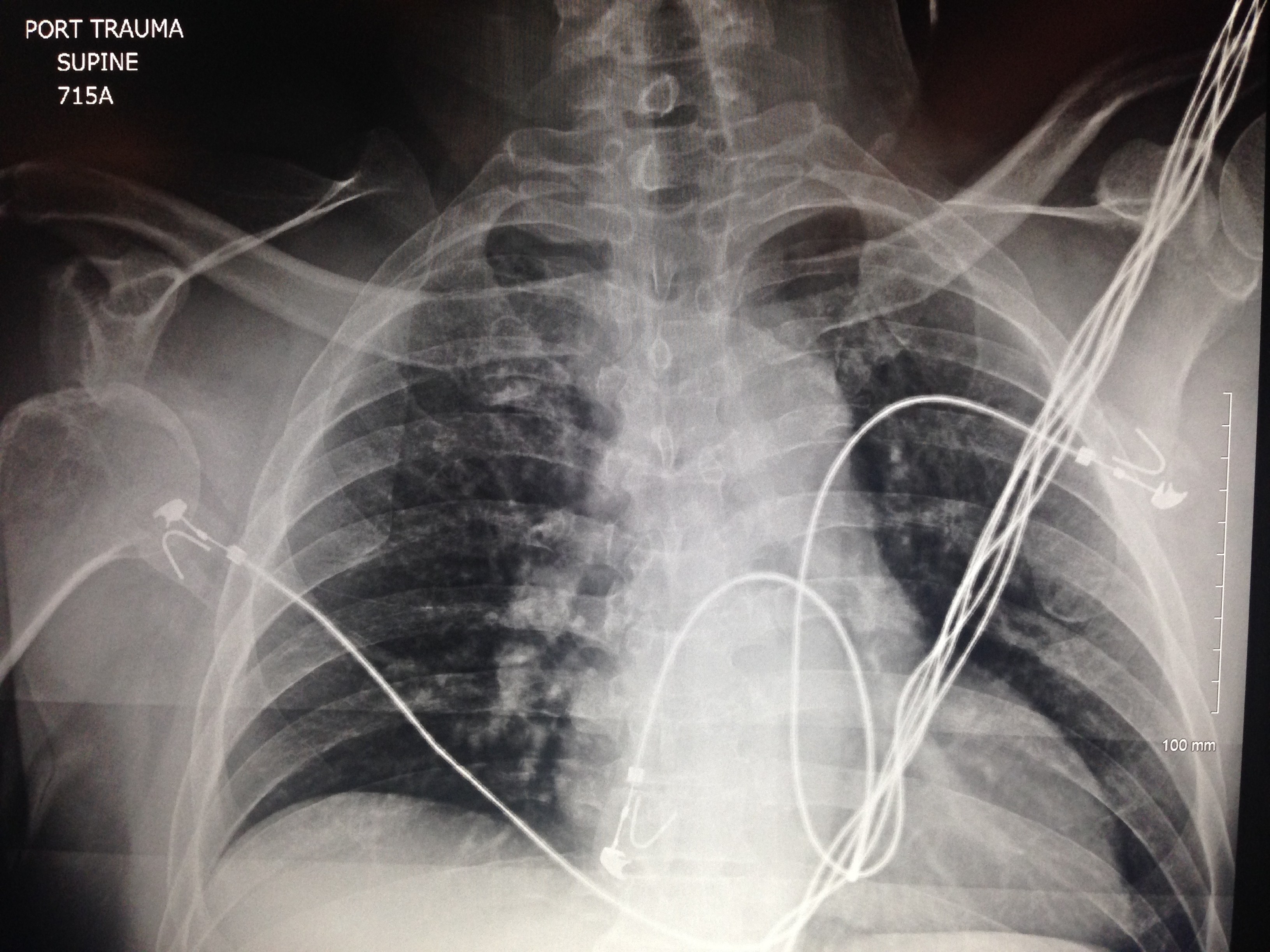 Inferior shoulder dislocation