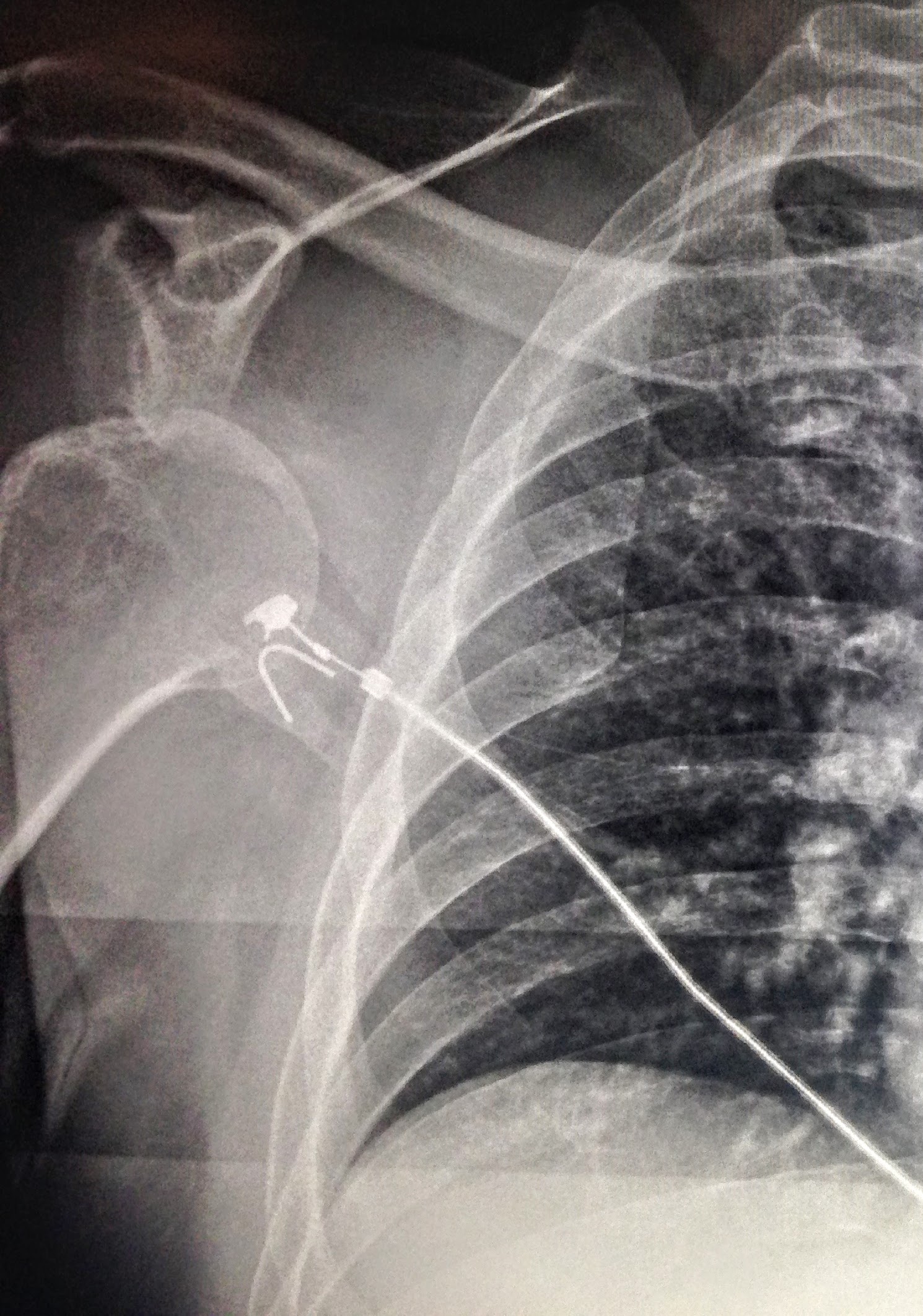 Inferior shoulder dislocation