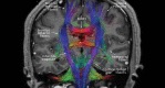 coronal tractography, corpus callosum, corticospinal tracts, white matter, terra incognita