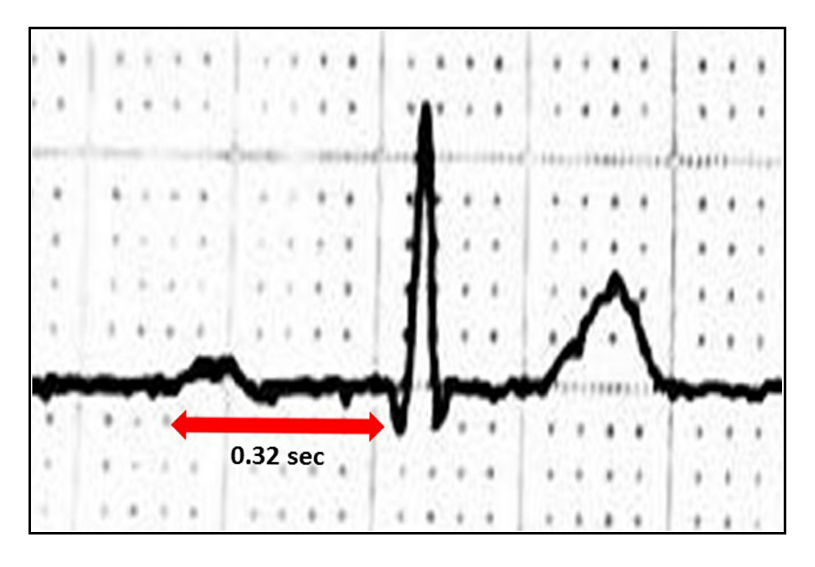 <p>First-Degree AV Block, Electrocardiogram