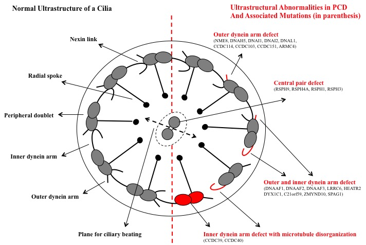 <p>Ciliary Dyskinesia