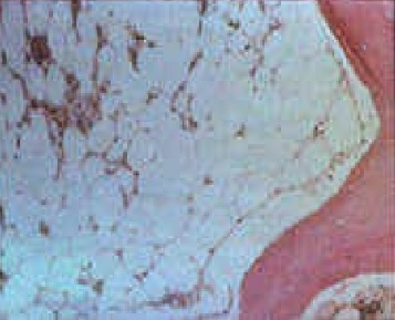 <p>Aplastic Anemia Bone Marrow