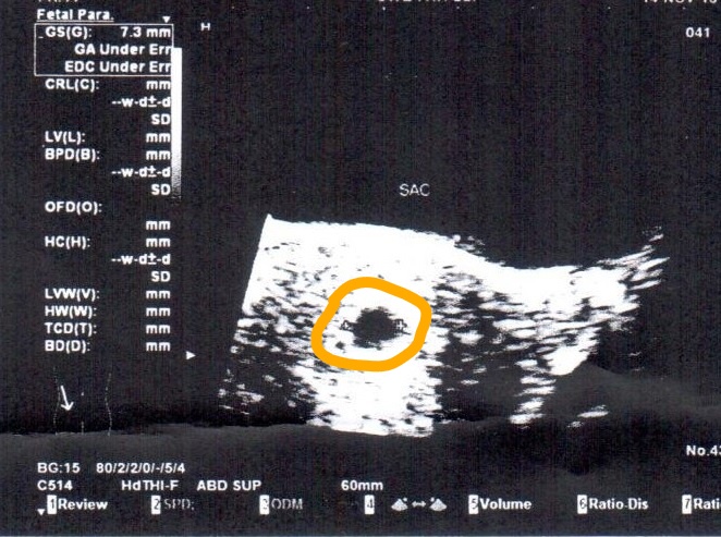 Final Transabdominal Ultrasound  at 8 weeks, shows 
gestational sac 7.3 mm with no fetus