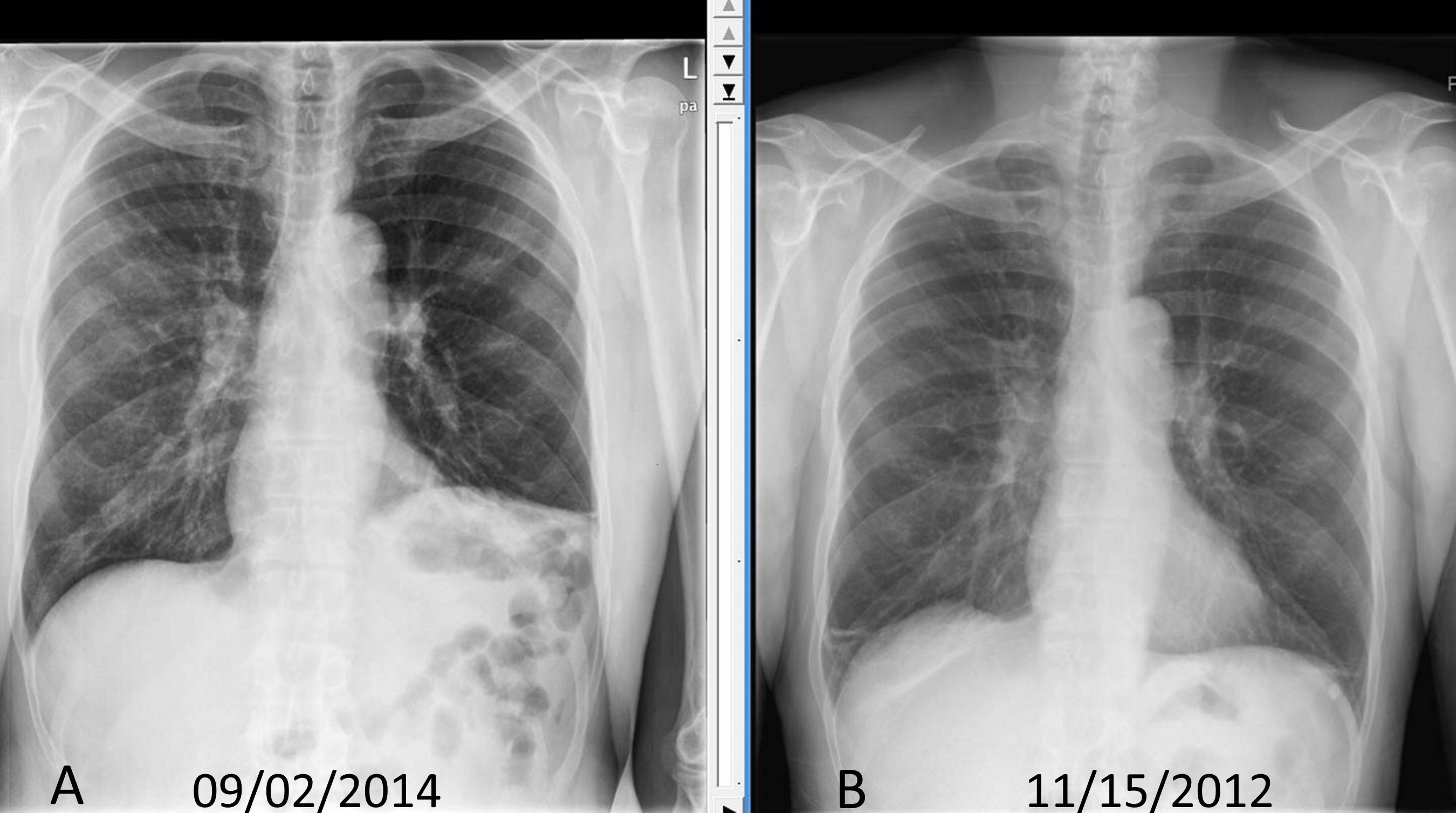 <p>Chest Radiograph Showing Diaphragm Disorder