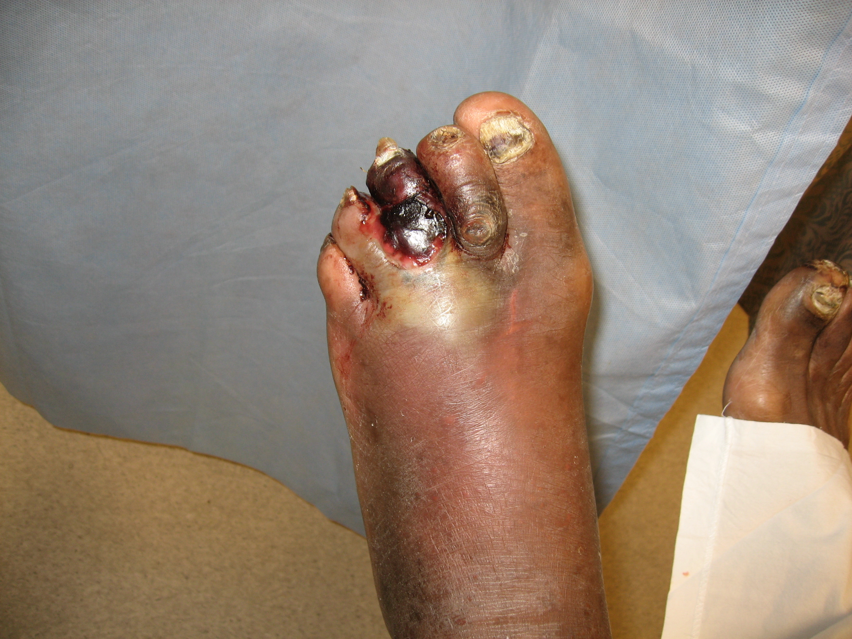 <p>Gas Gangrene in a Diabetic Foot