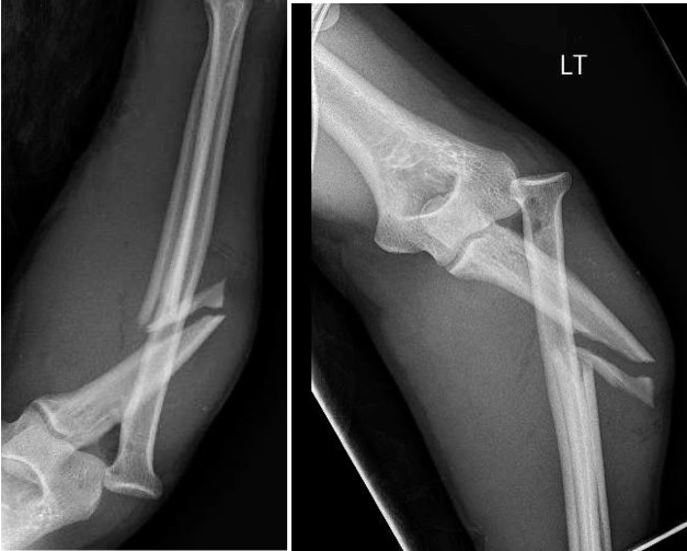 Monteggia Fracture