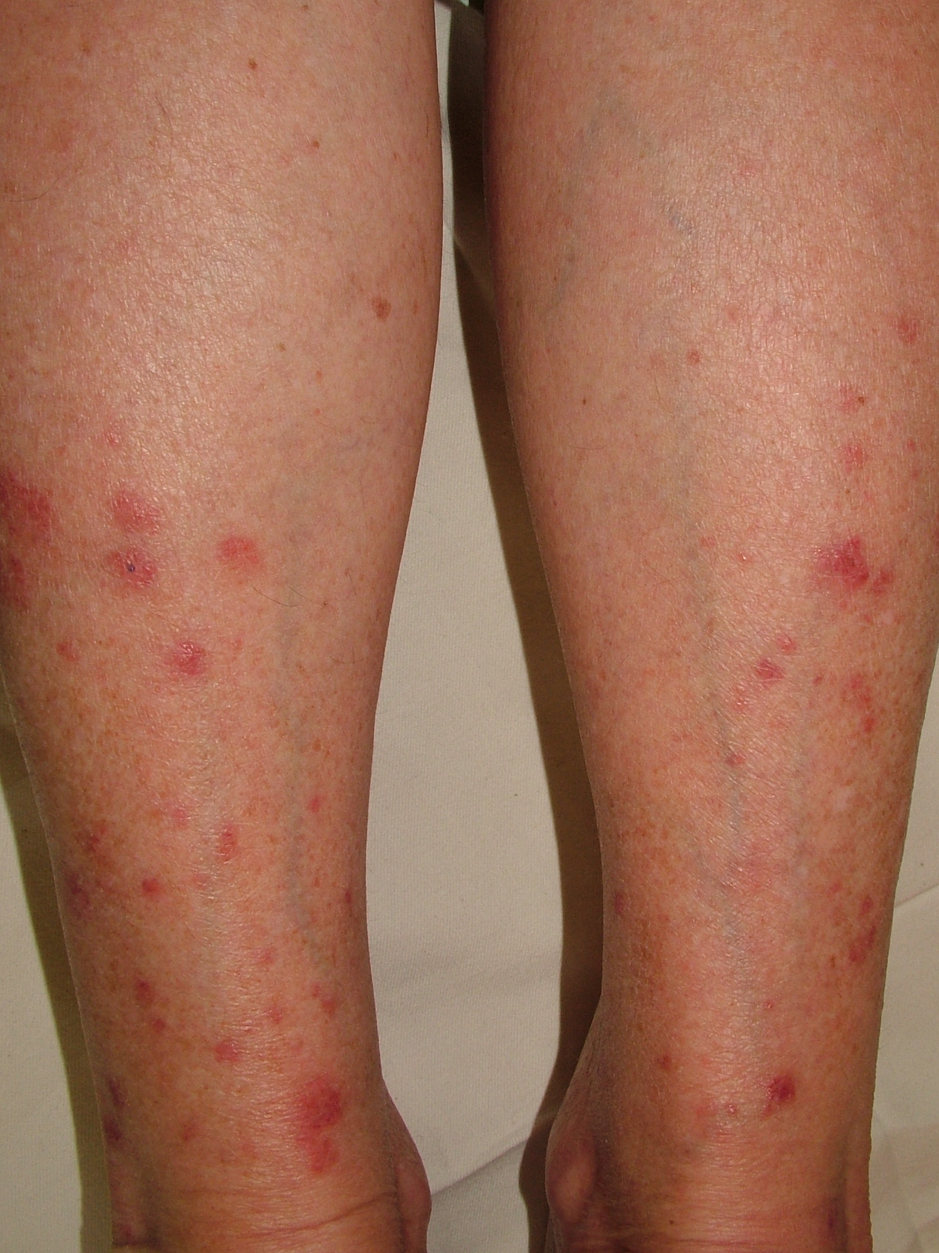 <p>Papular polymorphic light eruption on lower legs in female</p>