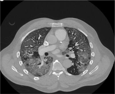 Chest CT showing ground glass opacities in AEP