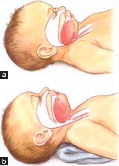 <p>Infant Airway