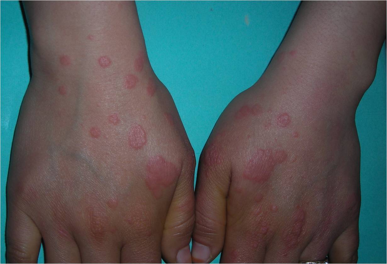 <p>Erythema Multiforme Lesions