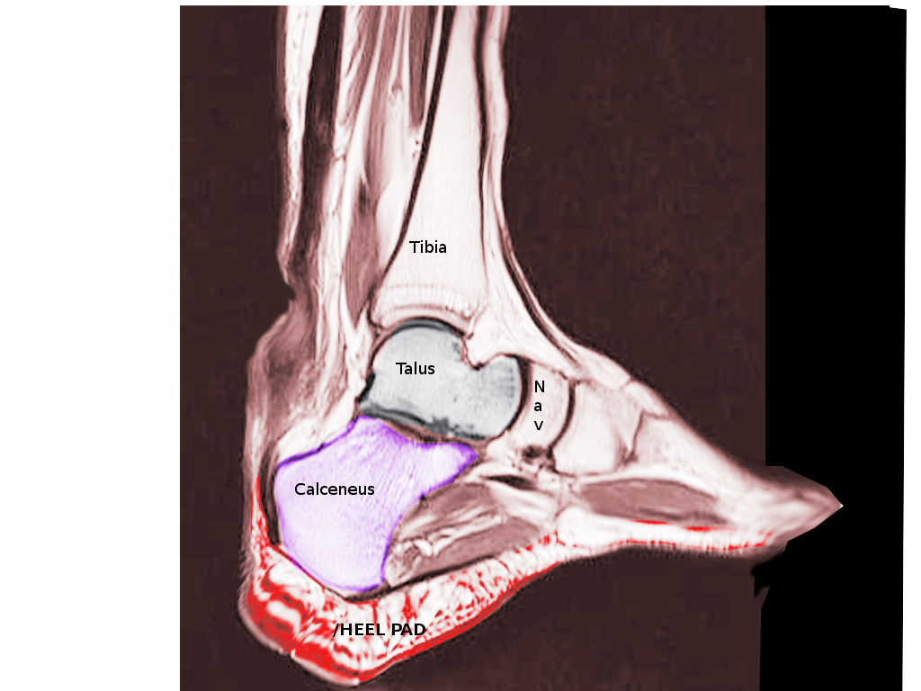 <p>Dorsal Radiograph,&nbsp;Achilles Tendon