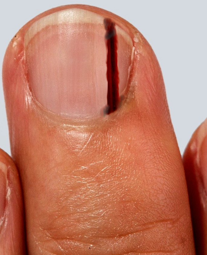 <p>Subungual Melanoma. Image demonstrating a subungual melanoma of the middle finger.</p>