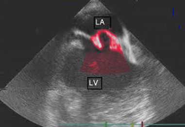 <p>Mitral Valve Prolapse Echocardiography</p>