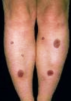 <p>Erythema Nodosum</p>