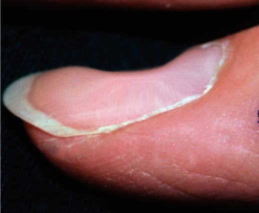 iron deficiency - spoon shaped nail