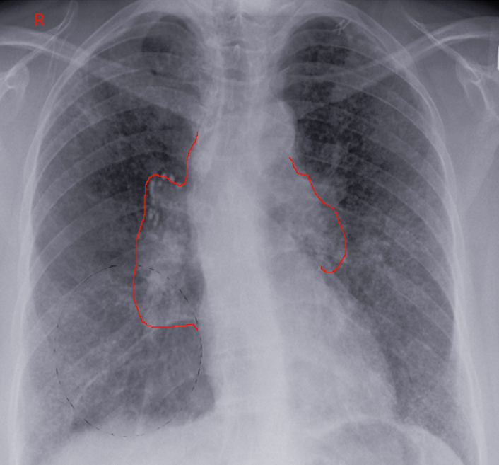 Bilateral hilar lymphadenopathy