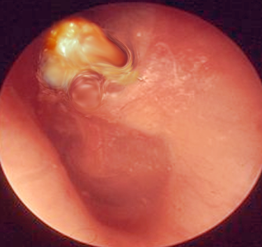 <p>Cholesteatoma in the Right Ear.</p>