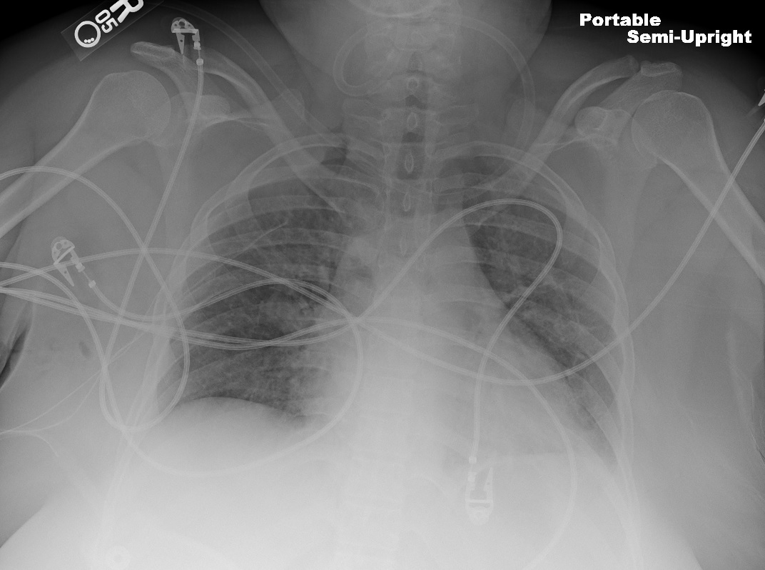 <p>Postoperative Thoracic Outlet Decompression