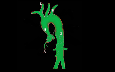 Supravalvular aortic stenosis