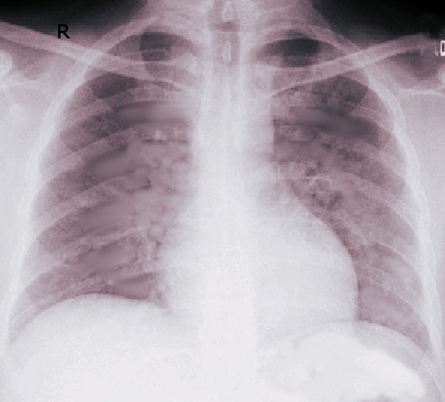 Acute Respiratory Distress Syndrome