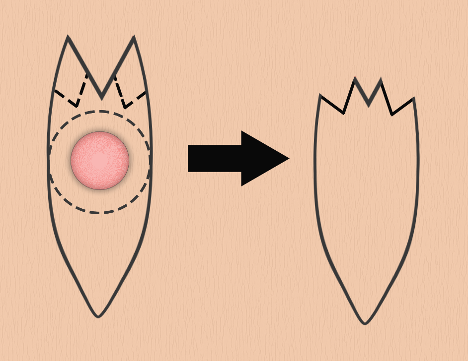 Nested M-plasty. Note the duplication of the M-plasty technique.