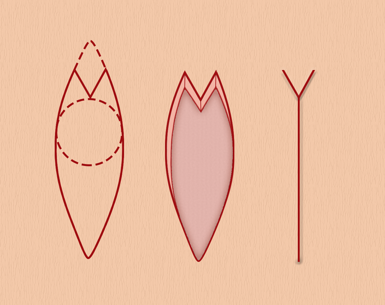 <p>Stages of an M-Plasty