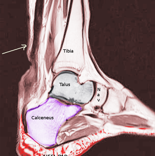 Achilles tendon rupture