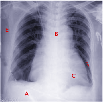 <p>Central Line, Pericardium</p>