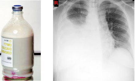 <p>Chest X-Ray Showing Chylothorax With Homogeneous Density.</p>