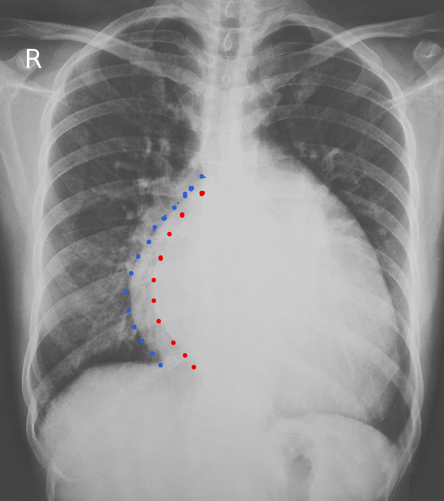 left atrial enlargement