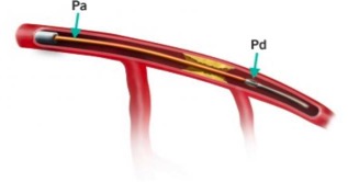 <p>Fractional Flow Reserve Procedure