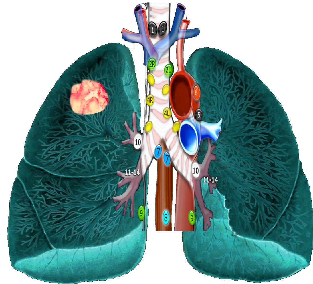 <p>Mediastinal Lymph Nodes</p>